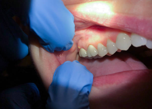 Best Emergency Broken Tooth Repair in Water Mill, NY
